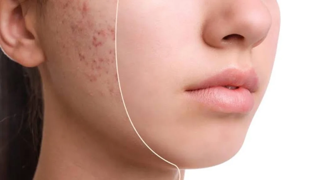 Bahan Skincare Efektif untuk Kulit Berjerawat